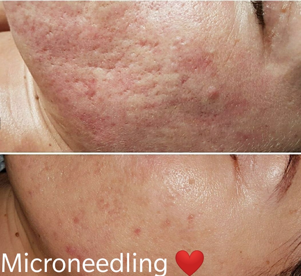 BB Glow Microneedling